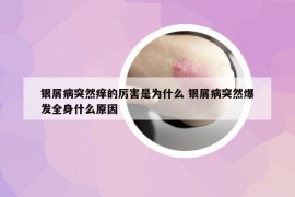 銀屑病突然癢的厲害是為什么 銀屑病突然爆發(fā)全身什么原因
