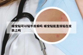 暖寶貼可以貼牛皮癬嗎 暖寶貼能直接貼在皮膚上嗎