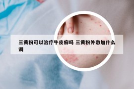 三黃粉可以治療牛皮癬嗎 三黃粉外敷加什么調(diào)