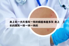 身上長(zhǎng)一大片像灰一樣的癬越來(lái)越多灰 身上長(zhǎng)的跟灰一樣一塊一塊的