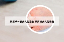 銀屑病一般多久能治愈 銀屑病多久能恢復(fù)