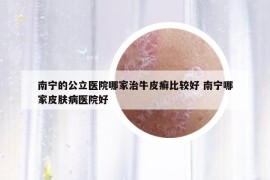 南寧的公立醫(yī)院哪家治牛皮癬比較好 南寧哪家皮膚病醫(yī)院好