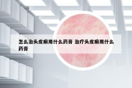 怎么治頭皮癬用什么藥膏 治療頭皮癬用什么藥膏