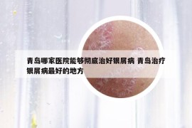 青島哪家醫(yī)院能夠徹底治好銀屑病 青島治療銀屑病最好的地方