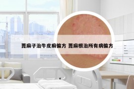 蓖麻子治牛皮癬偏方 蓖麻根治所有病偏方