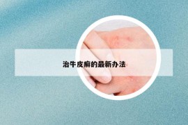 治牛皮癬的最新辦法
