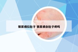 銀屑病拉肚子 銀屑病會(huì)肚子疼嗎