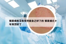 銀屑病有沒有突然就自己好了的 銀屑病幾十年突然好了