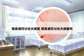 銀屑病可以吃大閘蟹 銀屑病可以吃大閘蟹嗎