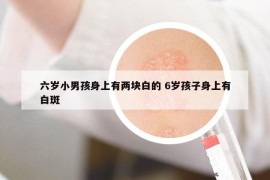 六歲小男孩身上有兩塊白的 6歲孩子身上有白斑