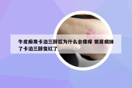 牛皮癬用卡泊三醇后為什么會(huì)瘙癢 銀屑病抹了卡泊三醇變紅了
