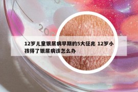 12歲兒童銀屑病早期的5大征兆 12歲小孩得了銀屑病該怎么辦
