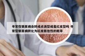 尋常性銀屑病會轉(zhuǎn)成點滴型或是紅皮型嗎 尋常型銀屑病轉(zhuǎn)化為紅皮膿包性的概率