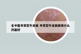名中醫(yī)尋常型牛皮癬 尋常型牛皮膚癬用什么藥最好