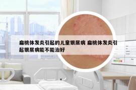 扁桃體發(fā)炎引起的兒童銀屑病 扁桃體發(fā)炎引起銀屑病能不能治好