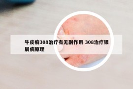 牛皮癬308治療有無副作用 308治療銀屑病原理