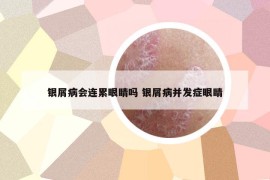 銀屑病會(huì)連累眼睛嗎 銀屑病并發(fā)癥眼睛