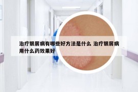 治療銀屑病有哪些好方法是什么 治療銀屑病用什么藥效果好
