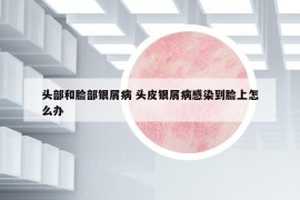 頭部和臉部銀屑病 頭皮銀屑病感染到臉上怎么辦