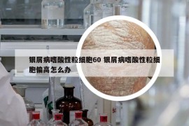 銀屑病嗜酸性粒細胞60 銀屑病嗜酸性粒細胞偏高怎么辦