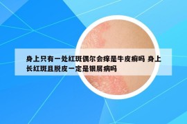 身上只有一處紅斑偶爾會癢是牛皮癬嗎 身上長紅斑且脫皮一定是銀屑病嗎