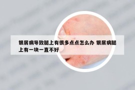 銀屑病導(dǎo)致腿上有很多點(diǎn)點(diǎn)怎么辦 銀屑病腿上有一塊一直不好
