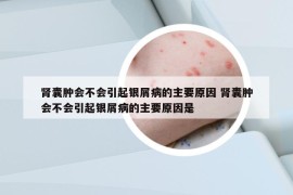 腎囊腫會不會引起銀屑病的主要原因 腎囊腫會不會引起銀屑病的主要原因是