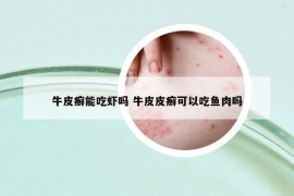 牛皮癬能吃蝦嗎 牛皮皮癬可以吃魚肉嗎