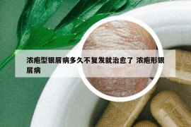 濃皰型銀屑病多久不復(fù)發(fā)就治愈了 濃皰形銀屑病