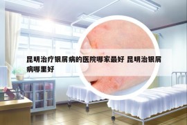 昆明治療銀屑病的醫(yī)院哪家最好 昆明治銀屑病哪里好