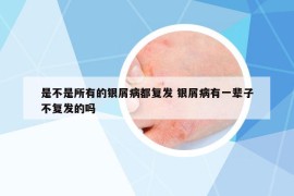 是不是所有的銀屑病都復發(fā) 銀屑病有一輩子不復發(fā)的嗎