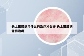 頭上銀屑病用什么藥治療才會(huì)好 頭上銀屑病能根治嗎