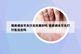 銀屑病關節(jié)炎針灸效果好嗎 銀屑病關節(jié)炎打針能治愈嗎