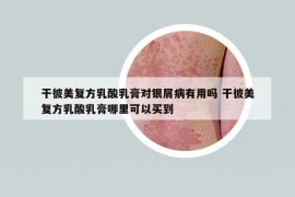 干彼美復(fù)方乳酸乳膏對銀屑病有用嗎 干彼美復(fù)方乳酸乳膏哪里可以買到
