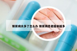 銀屑病太多了怎么辦 銀屑病患者越來越多