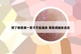 得了銀屑病一輩子不能健身 銀屑病健身自愈