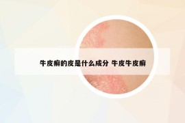牛皮癬的皮是什么成分 牛皮牛皮癬