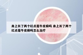 身上長(zhǎng)了兩個(gè)紅點(diǎn)是牛皮癬嗎 身上長(zhǎng)了兩個(gè)紅點(diǎn)是牛皮癬嗎怎么治療