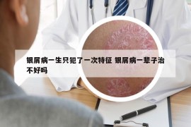 銀屑病一生只犯了一次特征 銀屑病一輩子治不好嗎