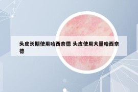 頭皮長(zhǎng)期使用哈西奈德 頭皮使用大量哈西奈德