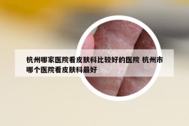 杭州哪家醫(yī)院看皮膚科比較好的醫(yī)院 杭州市哪個醫(yī)院看皮膚科最好