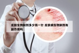 皮膚生物制劑多少錢(qián)一針 皮膚病生物制劑有副作用嗎
