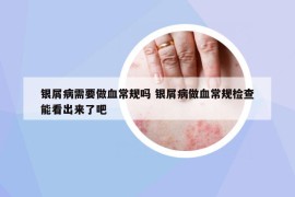 銀屑病需要做血常規(guī)嗎 銀屑病做血常規(guī)檢查能看出來(lái)了吧