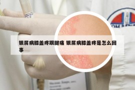 銀屑病膝蓋疼跟腱痛 銀屑病膝蓋疼是怎么回事