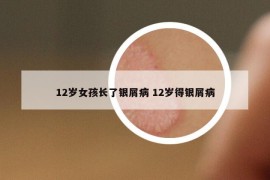 12歲女孩長了銀屑病 12歲得銀屑病