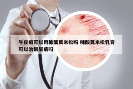 牛皮癬可以用糠酸莫米松嗎 糠酸莫米松乳膏可以治銀屑病嗎