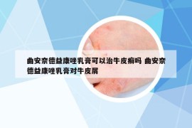 曲安奈德益康唑乳膏可以治牛皮癬嗎 曲安奈德益康唑乳膏對(duì)牛皮屑