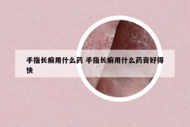 手指長癬用什么藥 手指長癬用什么藥膏好得快