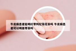 牛皮癬患者能喝紅棗枸杞菊花茶嗎 牛皮癬患者可以喝姜棗茶嗎