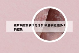 銀屑病做皮膚ct是什么 銀屑病的皮膚ct的結(jié)果